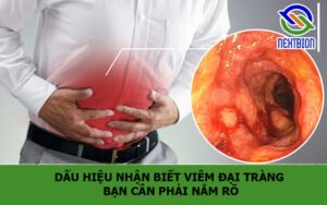 Dấu hiệu nhận biết viêm đại tràng bạn cần phải nắm rõ